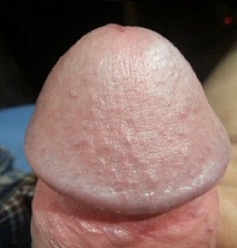 Fotografie a penisului glandului mărit