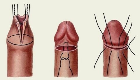 esența chirurgiei de mărire a penisului