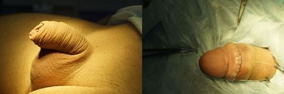 penis înainte și după operația de mărire