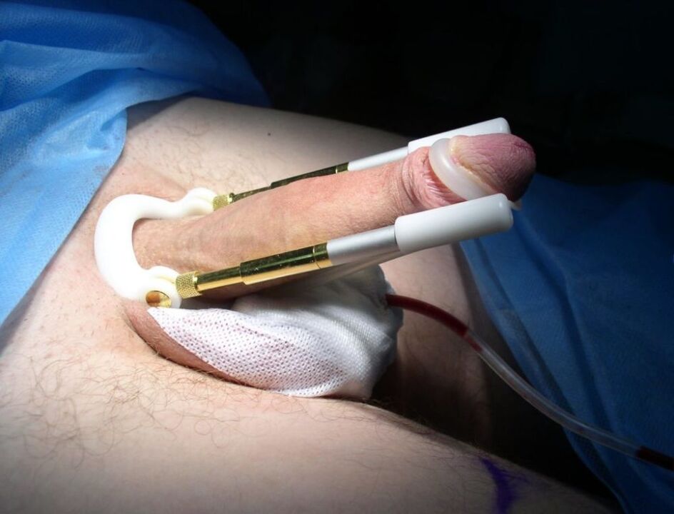 prelungitor după intervenția chirurgicală de mărire a penisului