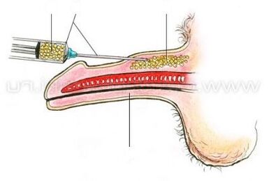 injectare marirea penisului